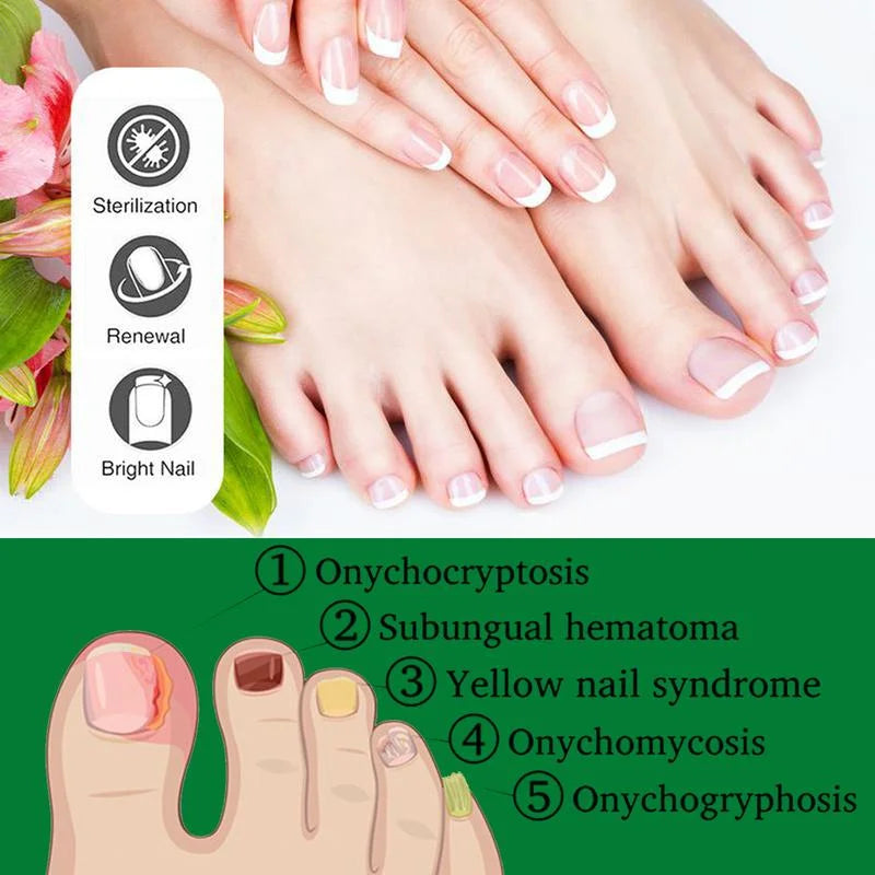 Nail treatment – Natural antifungal care 